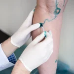 Effective Management Options for Varicose Veins