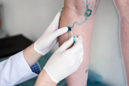 Effective Management Options for Varicose Veins