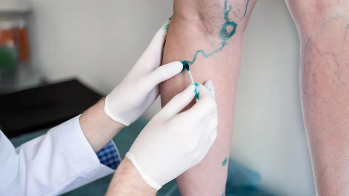 Effective Management Options for Varicose Veins