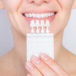 Understanding the Lifespan of Veneers