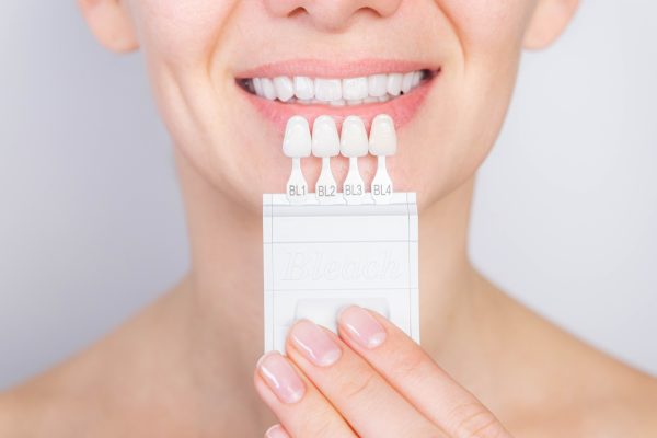 Understanding the Lifespan of Veneers